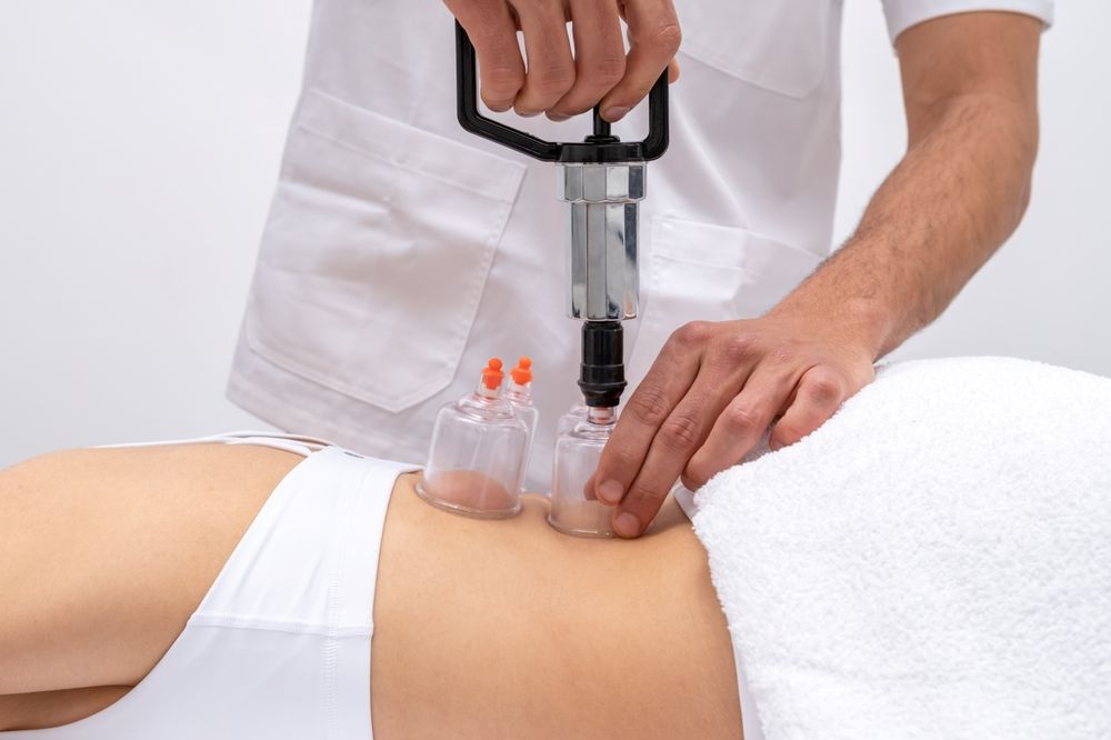 Cupping therapy treatment used for muscle tension relief.