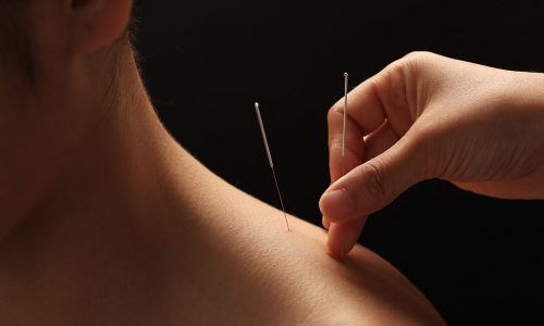 dry-needling